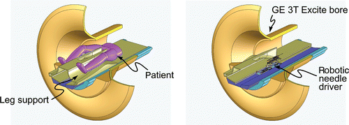 Figure 8. Closed-bore concept for MRI-guided needle placement. The patient's legs are placed on a leg support that provides a “tunnel” of access to the perineum. A compact robotic needle driver mechanism is placed into this tunnel as shown. [Color version available online.]