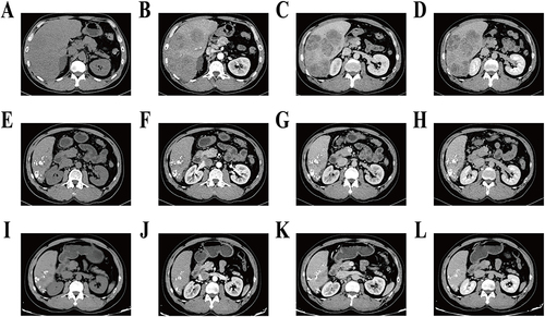 Figure 4 Comparison of CT results before and after four times of conversion therapy. (A–D) On June 10, 2021, the maximum extent of S5/6/7 tumor was about 14.1cm×7.6cm, (A) plain scan period; (B) arterial phase; (C) venous phase; (D) Delay period. (E–H) August 24, 2021, the maximum tumor size was about 7.5 cm × 4.7 cm, and the lymph nodes in the hepatic portal region and abdominal aorta were smaller than before, (E) plain scan period; (F) arterial phase; (G) venous phase; (H) Delay period. (I–L) On October 12, 2021, the tumor size was reduced to 7.0×2.9 cm, (I) plain scan period; (J) arterial phase; (K) venous phase; (L) Delay period.