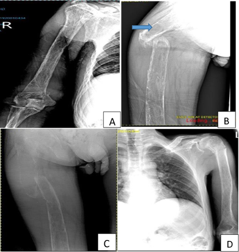 Figure 1 (A) Right proximal femur shaft pathologic fracture with decreased density of bone, (B) Lateral view, brown tumor (arrow), (C) Right supracondylar humeral fracture, (D) Left proximal humeral fracture.