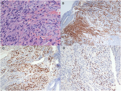 Figure 2. An IHC examination showed endothelial cell proliferation, fibroblast proliferation pericapillary, spindle cells were mild to moderate dysplasia, pathological mitosis was observed. (A) Erythropoietic hyaline corpuscles were found in the cells, red blood cells exuded and hemosiderin particles were deposited between the cell(HE × 200); (B) CD31 of tissue cell markers are positive in IHC staining(CD31 × 100); (C) CD34 of tissue cell markers is positive in IHC staining(CD34 × 100); (D) HHV-8 markers are positive in IHC staining(HHV-8 × 100).