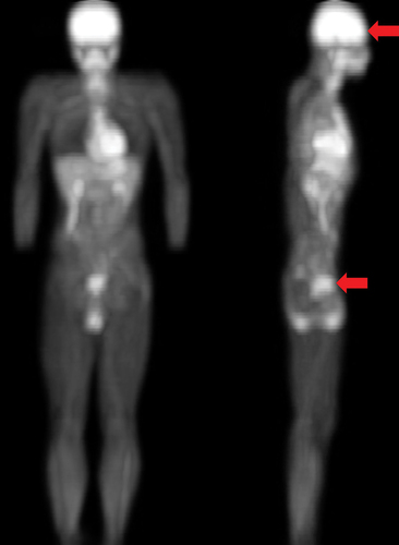 Figure 1. Positioning optical detection probe of near-infrared spectroscopy (NIRS). The whole body 18F-fluorodeoxyglucose positron emission tomography (PET) image indicates the metabolically active sub-navel and cerebral regions where the optical detection probes of near-infrared spectroscopy (NIRS) were placed (indicated by red arrows). PET scan was conducted 1 h after injecting glucose solution containing 18F-fluorodeoxyglucose (400 MBq) by a young participant (24 y) before scanning under overnight fasted condition.