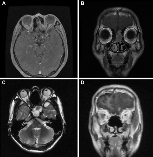 Figure 4 Representative MRI scans of a patient with olfactory neuroblastoma.