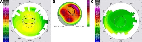 Figure 4 Case 3: corneal aberration cancellation via oblique aberration and cerebral processing.