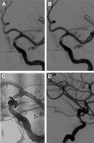 Figure 6 Head DSA images showing no aneurysm development, and the left internal carotid artery was recanalized.