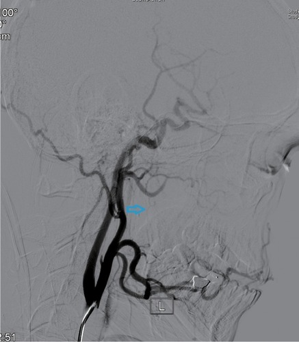 Figure 4 Post-embolization ascending pharyngeal artery angiogram revealing total occlusion of the artery (indicated by the arrow).Note: L= blood vessel on the left.