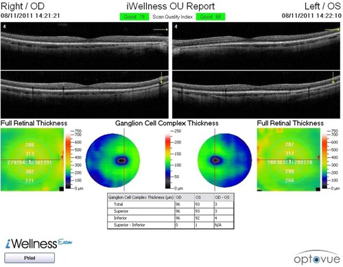 Figure 1 Category 1 iWellness™ OU report for subject J749, with a normal healthy retina and ganglion cell complex.