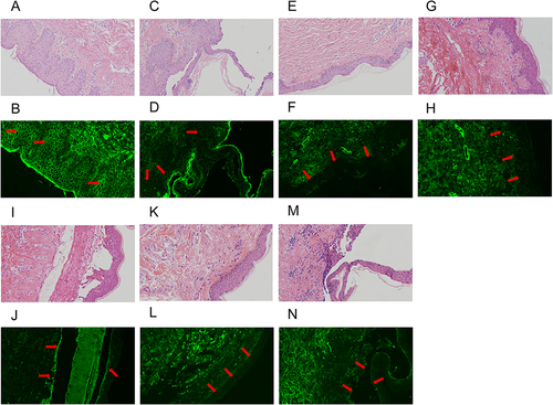 Figure 1 Representative examples of histopathological and immunofluorescent staining for pemphigus, bullous pemphigoid, epidermolysis bullosa acquisita and normal skin. (A) H&E staining at perilesion sites of pemphigus foliaceus. (B) DIF on paraffin tissue sections of positive IgG staining at perilesion sites of pemphigus foliaceus. (C) H&E staining at lesion sites of pemphigus foliaceus. (D) DIF on paraffin tissue sections of positive IgG staining at lesion sites of pemphigus foliaceus which is less strong than that of the perilesion site. (E) H&E staining of normal skin. (F) No IgG deposition is observed between spinous cells and along basement membrane zone by DIF on paraffin tissue sections in normal skin. (G) H&E staining at perilesion sites of bullous pemphigoid. (H) No IgG deposition is observed along basement membrane zone at perilesion sites by DIF on paraffin tissue sections of bullous pemphigoid. (I) H&E staining at lesion sites of bullous pemphigoid. (J) No IgG deposition is observed along basement membrane zone at lesion sites by DIF on paraffin tissue sections of bullous pemphigoid. (K) H&E staining at perilesion sites of epidermolysis bullosa acquisita. (L) No IgG deposition is observed along basement membrane zone at perilesion sites by DIF on paraffin tissue sections of epidermolysis bullosa acquisita. (M) H&E staining at lesion sites of epidermolysis bullosa acquisita. (N) No IgG deposition is observed along basement membrane zone at lesion sites by DIF on paraffin tissue sections of epidermolysis bullosa acquisita. DIF, direct immunofluorescence; H&E, hematoxylin and eosin.