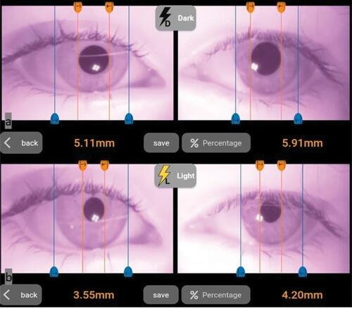 Figure 2 Measurement of pupillary diameter of both eyes in dark (A) and in light (B) illumination conditions using our custom designed application in a patient with anisocoria.