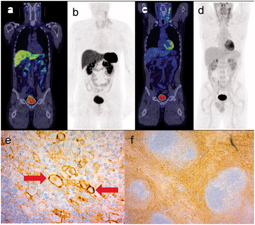 Figure 3. 68Ga-DOTANOC PET/CT (a) and maximum intensity projection (MIP) (b) whole body images of a patient with Hodgkin’s lymphoma of nodular sclerosis type showing multiple positive left neck nodes and concurrent findings on corresponding FDG PET/CT images (c, d). IHC of subtype 2 (e) is positive for the cell membrane of the neoplastic Reed–Sternberg cells (arrows), while IHC of subtype 3 (f) shows staining of collagen bands.
