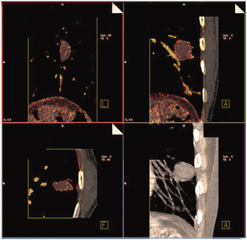 Figure 2. DECT image. Iodine overlay superimposed with the virtual non-contrast images.