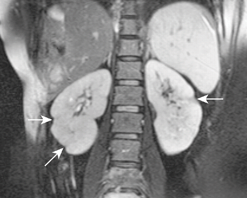 Figure 2. Follow-up T2W coronal magnetic resonance image of the patient showing that the segmental infarction areas healed with scarring (arrows).
