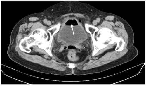 Figure 3 The computed tomography scans showing gas–fluid level within the urinary bladder (arrow).