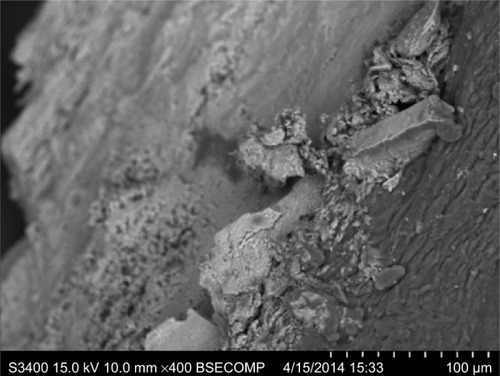 Figure 3 Scanning electron microscopy. Large calcified lumps. Backscatter electron imaging. Scale bar −100 microns.