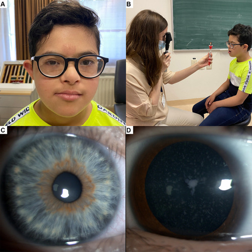 Figure 1 Ocular anomalies in Down syndrome. (A) Eleven year old boy with Down syndrome, myopia and hypoaccommodation wearing bifocal spectacles. (B) Evaluation of accommodation by dynamic retinoscopy. (C) Brushfield spots: white iris nodules arranged circumferentially; an area of thinner iris stroma is noted peripheral to the nodules. (D) Blue dots cataract in a 16 year old boy with Down syndrome.