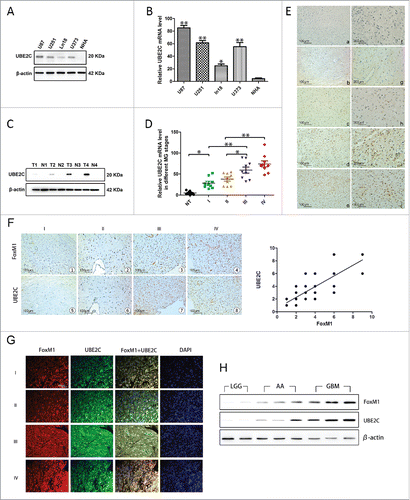 Figure 1. UBE2C overexpression and its correlation with FoxM1 in human gliomas. (A) The Western blot analysis showed varied UBE2C expression in MG U87, U251, Ln18, and U373 cell lines, whereas no UBE2C protein was expressed in NHAs. (B) The qRT-PCR results show the relative UBE2C mRNA expression levels in the above glioma cell lines; very little UBE2C mRNA expression was observed in NHAs; *p < 0.05, **p < 0.01 vs. NHAs. (C) Western blot analysis results of gliomas of different WHO grades, where T1-T4 refer to grades I to IV, and N indicates adjacent normal brain tissues. (D) The UBE2C mRNA expression levels in MG tissues of different stages; normal brain tissues were used as a control; *p < 0.01, **p < 0.001. (E) IHC with UBE2C antibodies on NHB and MG tissues. Magnification × 200: (a) NHB tissue; (b) pilocytic astrocytoma (WHO grade I); (c) diffuse astrocytoma (WHO grade II); (d) aplastic astrocytoma (WHO grade III); (e) GBM (WHO grade IV); (f-j) magnification × 400 of the corresponding pictures on the left. (F) Upper panel, FoxM1 expression was examined by IHC in 154 glioma specimens of different WHO grades and in 27 normal tissues. Representative images are shown. Lower panel, the level of UBE2C staining in the adjacent slices. Magnification x200 (r = 0.789, p < 0.001). (G) Immunofluorescence assay showing the colocalization of FoxM1 with UBE2C in 154 specimens. Representative images are shown. Scale bar, 200 µm. (H) FoxM1 and UBE2C protein expression levels were determined by Western blot analysis with protein extracts from 2 LGG, 3 AA and 3 GBM frozen tissue samples.