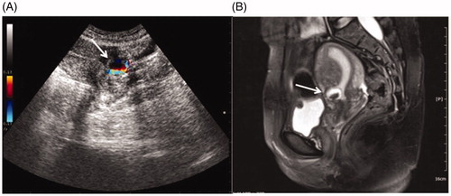 Figure 1. Ultrasound image and MRI obtained from a patient with CSP. A, The transabdominal ultrasound image showed a gestational sac (white arrow) embedding at the scar site of the previous CS with empty uterus cavity and cervical canal. Color Doppler reveals a rich blood supply surrounding gestational sac. B, A saggittal view MR image showed a gestational sac (white arrow) embedding at the site of the previous CS scar.