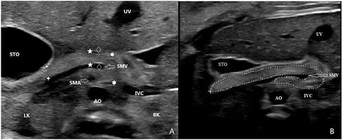 Figure 1. Visualization of 24+6W fetal pancreas using high-frequency transducers (3–12MHz). Measurement method of fetal pancreas head, neck, body, and tail(a). the measurement positions were located in front of the inferior vena cava(head, Display full size), superior mesenteric vein(neck, Display full size), superior mesenteric artery(body, Display full size) and left kidney(tail, Display full size), respectively. Freehand tracing of pancreas circumference(B). the pancreas was traced from the left caudal edge to the right edge, and the circumference and area were measured.AO: abdominal aorta; IVC: inferior vena cava; LK: left kidney; RK: right kidney; SMA: superior mesenteric artery;SMV: superior mesenteric vein; STO: stomach; UV: umbilical vein