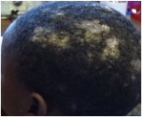 Figure 14 Hair loss, marked crusting and Kerion formation.