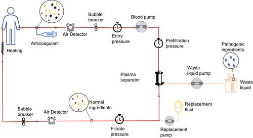 Figure 1 The principle of plasma exchange (PE). The blood is separated from the body, processed and then passed through a single plasma separator. The filtered blood components are returned to the body together with the replacement fluid.