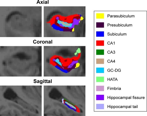 Figure 1 Illustration of parcellation scheme used for automated hippocampal subfield segmentation: axial view, coronal view, sagittal view. Images are from a control subject.