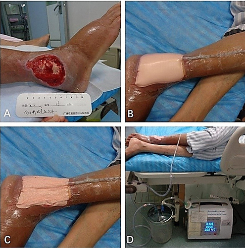 Figure 2 The clinical course of Negative Pressure Wound Therapy (NPWT) for DLEUs. (A) The cleaning and assessment of the wound. (B) The schematic representation of the NPWT initiation. (C) The schematic representation of the process of NPWT. (D) The schematic and device diagram of NPWT.