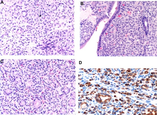 Figure 2 Hematoxylin and eosin staining of the gastric specimen demonstrating strands of invasive cells in the mucosa.