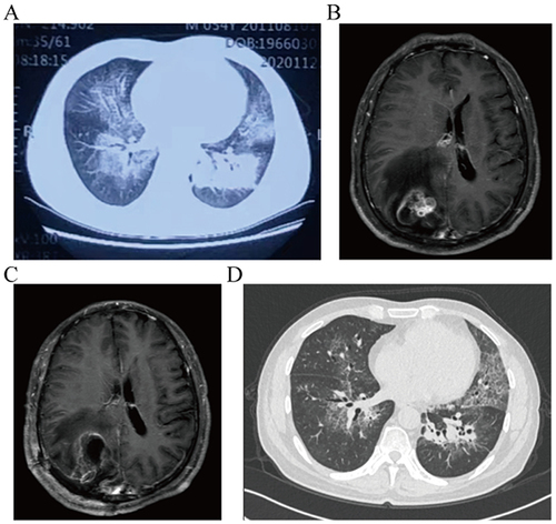 Figure 1 (A) Initial lung CT revealed that bilateral patchy exudation with increased density and indistinct margins. (B) Initial brain enhanced MRI revealed that an irregular mass measuring 3.5×2.5×3.2cm was identified in the right occipital lobe, exhibiting significant enhancement with an uneven ring and large flake edema surrounding it. The adjacent cerebral sulci were narrowed and disappeared, while compression caused narrowing of the right lateral ventricle. (C) Second brain enhance MRI, conducted 9 days after craniotomy, revealed an improvement in the compression of the right lateral ventricle. (D) Second chest CT, conducted 1 month after antifungal treatment, showed significant absorption of the lesion.