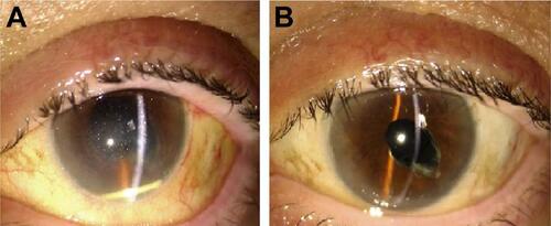 Figure S1 Anterior chamber migration of the long-acting intravitreal dexamethasone implant with corneal edema in an aphakic patient.Notes: Postural maneuvres with previous pupil dilation allowed correct repositioning of the implant with full resolution of the corneal edema and restoration of the VA before the complication. (A) Migration of the dexamethasone intravitreal implant into the anterior chamber. (B) Resolution of corneal edema after repositioning of the device into the vitreous chamber.Abbreviation: VA, visual acuity.