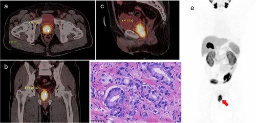 Figure 1. A 69-y-old male with prostate adenocarcinoma (International Society of Urological Pathology grade 5; Gleason Score: 4 + 5 = 9; PSA = 45.33 ng/ml), with 18F-PSMA-1007 PET/CT images depicting manually drawn VOI of major lesion in three planes and a two-dimensional ROI in the right gluteus maximus. A. Axially fused PET/CT, SUVmax: 14.47, SUVmean: 7.37, iPSMA-TV: 20.73 cm3, iTL-PSMA: 152.78 cm3, TBR: 17.43. The concentration of the imaging agent was significant at the prostate cancer site. B. Coronally fused PET/CT. C. Sagittal fused PET/CT. D. Pathological images, HE staining (×400); microscopically, small and irregular glands were observed, with local glandular fusion, co-wall, and locally scattered individual tumor cells. E. Maximum intensity projection(MIP) image.