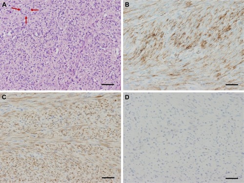 Figure 5 Pathological images of the tumor. (A) Hyperchromatic fibroblast-like cells with mild nuclear atypia and occasional mitotic activity on H&E staining (×200, scale bar 50 μm); focal osteoid production (red arrow) was present within the moderately cellular fibroblastic stroma; (B) shows strong positive staining for SMA on immumohistochemical staining (×200, scale bar 50 μm); (C) shows strong CDK4 positivity of the tumor on immumohistochemical staining (×200, scale bar 50 μm); (D) shows focal weak MDM2 positive on immumohistochemical staining (×200, scale bar 50 μm).
