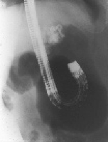 Figure 1b Image of fluoroscopic observation with infusion of 70% Histoacryl to determine the extent of the varices.