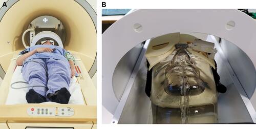 Figure 1 (A) Setup for high-resolution ocular magnetic resonance (MR) imaging, consisting of a dedicated receive eye-coil, with an integrated mirror. A fixation target is projected onto the screen at the end of the magnet bore. A cued-blinking paradigm is used to minimize blink-induced artefacts. (B) This image demonstrates how the patient's head is positioned within the MRI (magnetic resonance imaging) with the eye coil secured around the head.