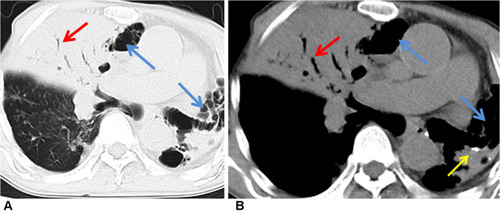 Figure 2 Pulmonary MALT lymphoma in a 65-year-old man. (A) Axial lung-window HRCT showed consolidation with air bronchogram (red arrow). There was cystic bronchiectasis (blue arrow) within the lesion in the right middle lobe and left lower lobe. (B) Mediastinum-window showed consolidation with air bronchogram (red arrow) and cystic bronchiectasis (blue arrow), and spot calcification in the lesion (yellow arrow).