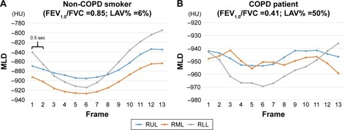 Figure 3 Mean lung density (MLD) time curves of three lung lobes in the right lung.Notes: In a smoker without COPD (A), the three MLD time curves of the three lung lobes have similar shapes, which indicates synchronous respiratory movements of the lobes (cross-correlation coefficient [CCC] of three pairs =0.975–0.996). A larger change in MLD in the lower lobe than in the upper and middle lobes suggests that respiratory volume changes mainly occur in the lower lobe in this subject. In a severe COPD patient (B), the three MLD time curves are unmatched, resulting in uncertain inspiratory/expiratory movements. Note that nearly opposite MLD curves of the middle and lower lobes are observed (CCC =−0.135), suggesting that asynchronized respiratory airflow exists in this patient.Abbreviations: FEV1.0/FVC, forced expiratory volume in one second/forced vital capacity; LAV%, percentage low attenuation volume (<−950 HU); RUL, right upper lobe; RML, right middle lobe; RLL, right lower lobe.