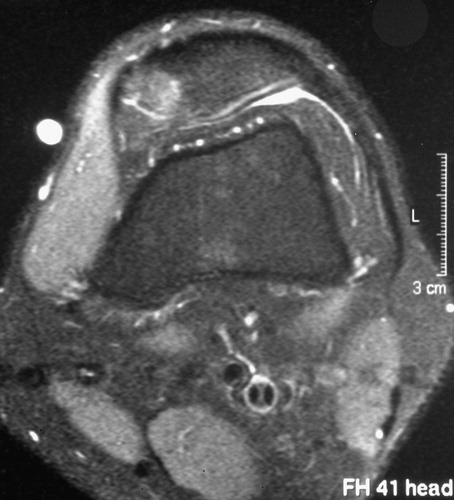 Figure 1. Preoperative diagnostics with an MRI scan of a patient with unspecific knee pain. The osteoid osteoma lesion was located in the postero-medial facet of the patella.