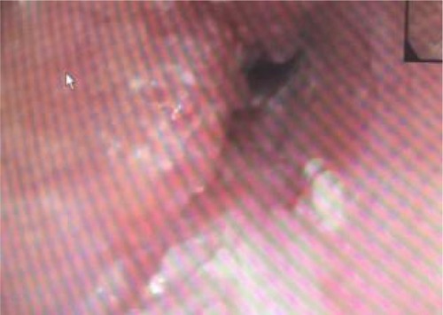 Figure 1 Esophago-gastro-duodenoscopy imaging.