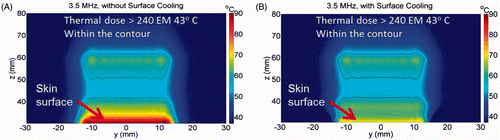 Figure 4. Simulated temperature distribution and thermal dose contours (inner contour > 240 EM 43°C) for the 3.5 MHz transducer, (A) without skin cooling and (B) with skin pre-cooling after 30 seconds of sonication, with transducer emittance of 3 W/cm2. The skin surface is at z = 30 mm. The skin temperature prior to ablation was 8°C. The red and brown arrows point to the predicted ablated regions in the focal plane and skin areas, respectively.