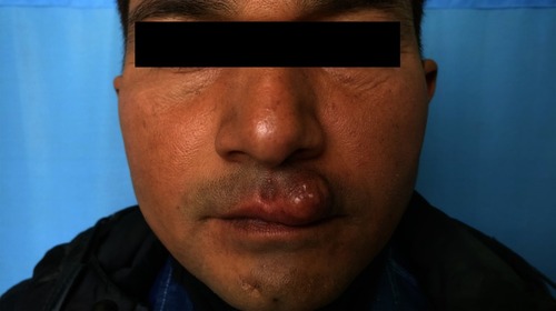 Figure 1 A 1.5 cm diameter nodule on left half of upper lip before excison.