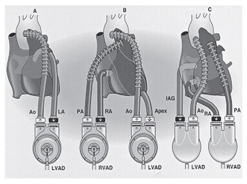 Figure 6 Thoratec pVAD implant configurations allow for LVAD, RVAD and BiVAD support, reprinted with permission from Thoratec Corporation.