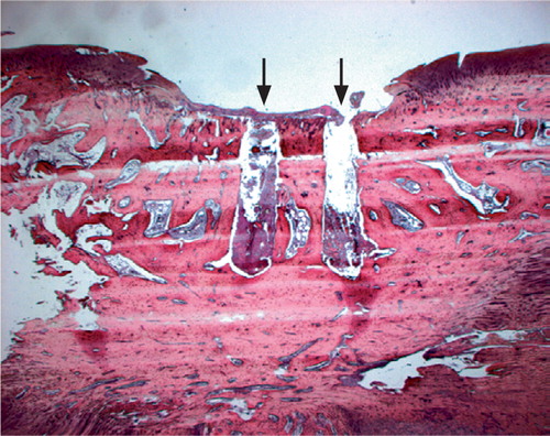 Figure 1 Histology from the cartilage defect after two weeks. The periosteal flap is detached from the cartilage defect and only a loose fibrous tissue remains in the defect. Arrows illustrate the penetration of the subchondral bone plate into the bone marrow from the hand-drive drill (HE, ×  1.25).