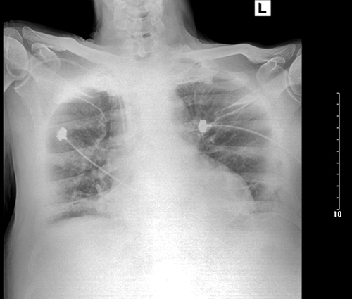 Figure 2 Chest X-ray obtained after re-admission to ICU. Notable for the widened mediastinum.