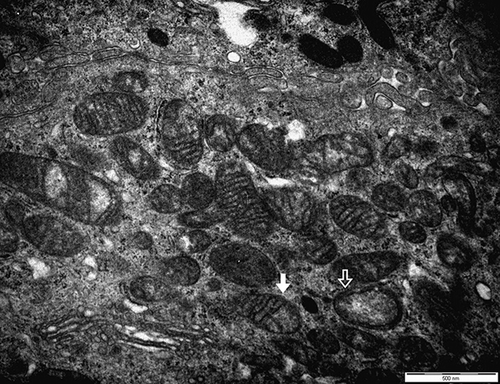 Figure 4.  The section shows that the outer membranes of mitochondria are ruptured and the cristae are disrupted (white arrow). A few mitochondria show vacuolated changes (hollow arrow) (first male, electron microscopy, ×20,000).