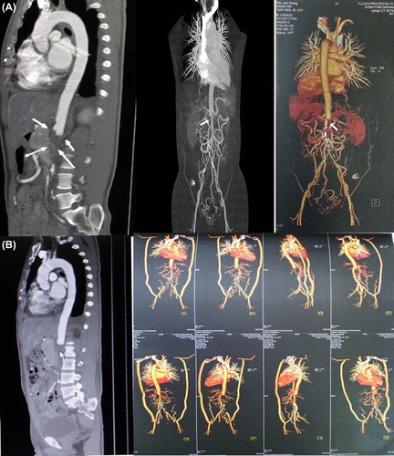 Figure 4. (A) After review of the case: computed tomography aortography (CTA) showing abdominal aortic thrombosis (arrows) that resulted in arterial occlusion extending from the left renal artery initial segment level to the bilateral common iliac artery and the bifurcation of the renal artery. Multiple collateral channels were seen in the bilateral renal artery, mesenteric artery and bilateral iliac artery, accompanied by transmural calcification. (B) After bilateral artificial subclavian–iliac bypass: CTA showing abdominal aortic thrombosis (arrow) that resulted in arterial occlusion extending from the left renal artery initial segment level to the bilateral common iliac artery and the bifurcation of the renal artery, except for the vascular bypass.