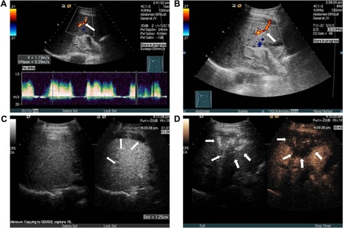 Figure 2 (A and B) Active bleeding originated from the puncture tract with a velocity of 1.13 m/s (arrowheads). (C) A 1.3 cm crescent-shaped free fluid was detected by sonography around the liver (arrowheads). (D) After microwave ablation, contrast-enhanced sonography did not show any microbubble extravasation inside the liver (arrowheads).
