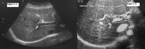 Fig. 1.  (A) Portal vein ultrasonographic image and (B) color Doppler demonstrating the presence of PVT.