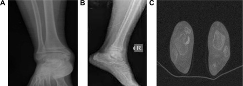 Figure 1 Ankle images of the patient.