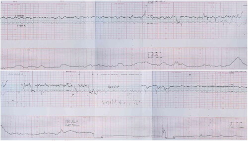 Figure 1. Cardiotocography of both fetuses (Twin A, sinusoidal heart rate patterns; Twin B, nonreactive).