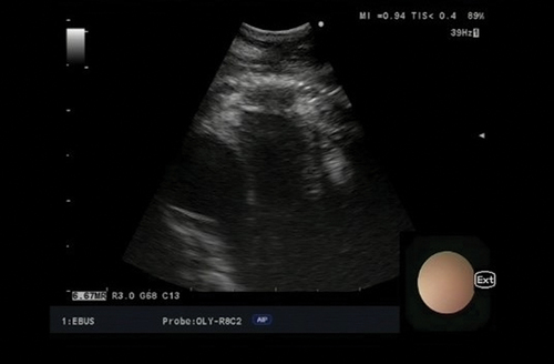 Figure 4. EUS-B image of mediastinal lymph node station 4 R.
