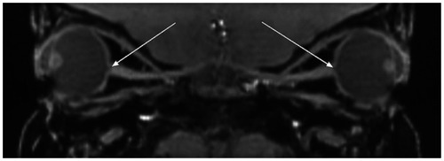 Figure 6 Sagittal reformation of thin section T1-weighted orbital images demonstrating enlarged cup-to-disk ratios bilaterally with optic nerve excavation.