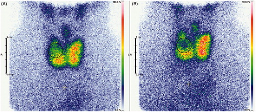 Figure 3. Exemplary scintigraphic imaging of a goitre pre-ablative (A), and 1 day post-ablation (B). Nodular Tc-99m pertechnetate uptake reduction is clearly visible.